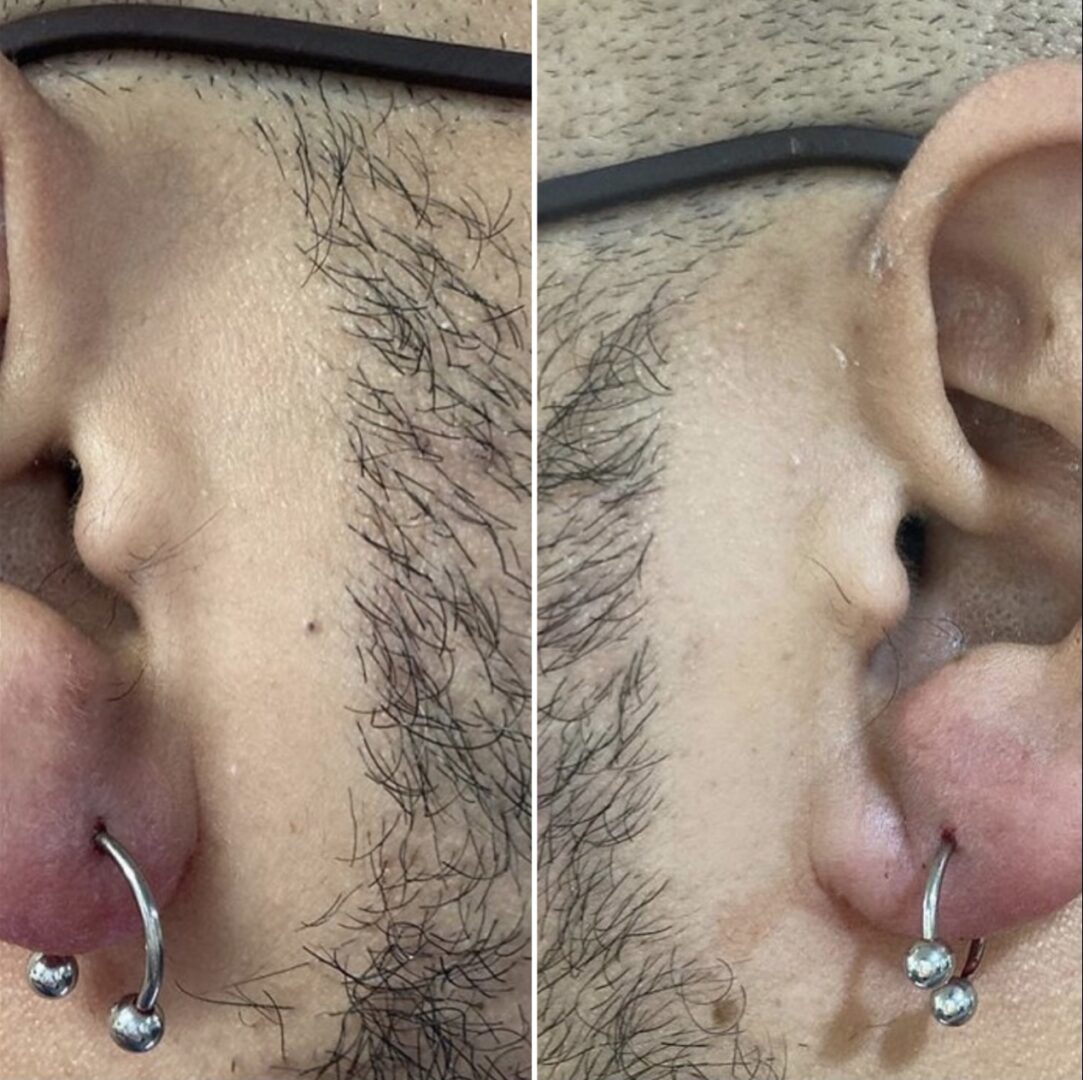 A man with his ear piercings and the other ear is missing.
