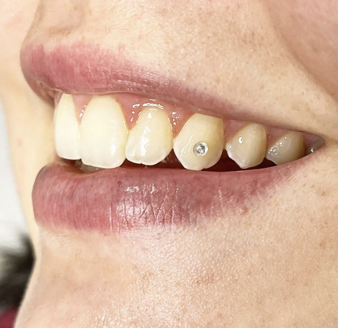 A woman with teeth that are missing some of them.